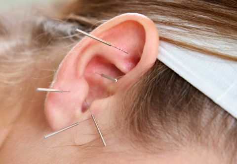 Island Acupuncture & Massage, Aricular Acupuncture