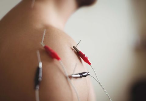 Island Acupuncture & Massage, Electro Acupuncture